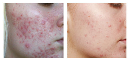 Foto van voor de behandeling en na de behandeling. De acne is zichtbaar afgenomen.