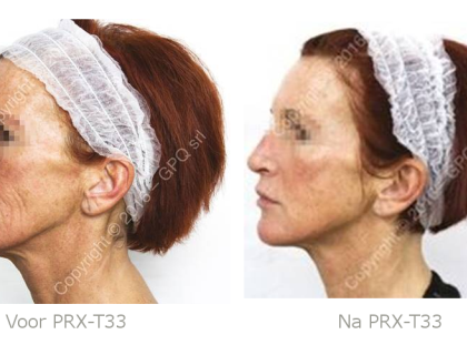 PRX-T33 NO-NEEDLE-SKIN-BOOSTER